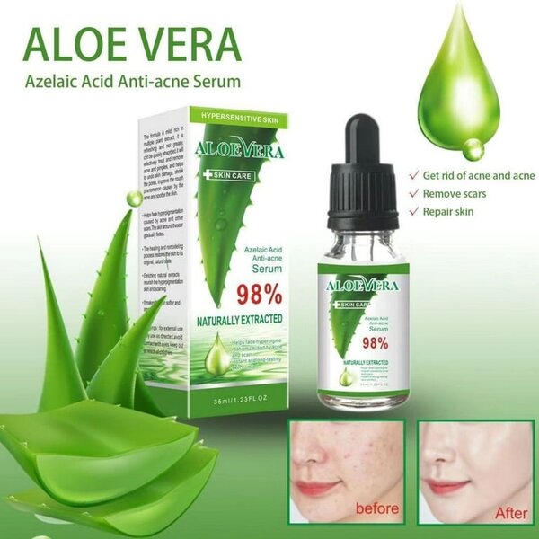 Aloe Vera facial acne remover serum