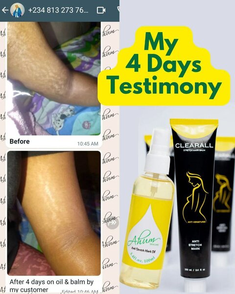 Scar and stretch Mark cream and oil