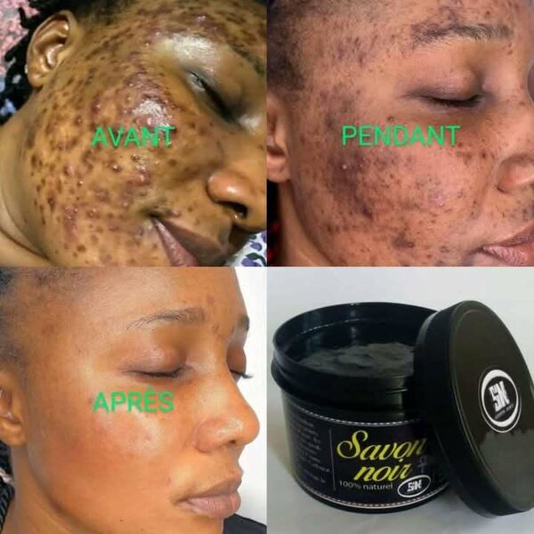 Savon Noir - Solution Anti-Imperfections