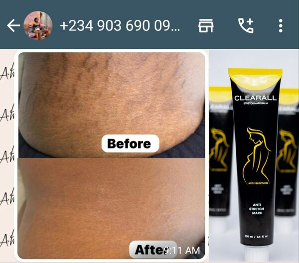Scar and stretch Mark cream and oil