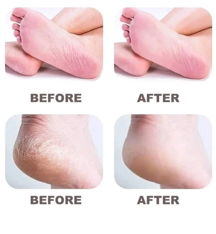 Appareil Électrique Pédicure