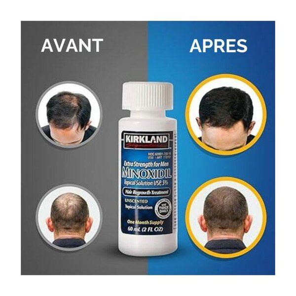 Kirkland Minoxidil 5% Homme