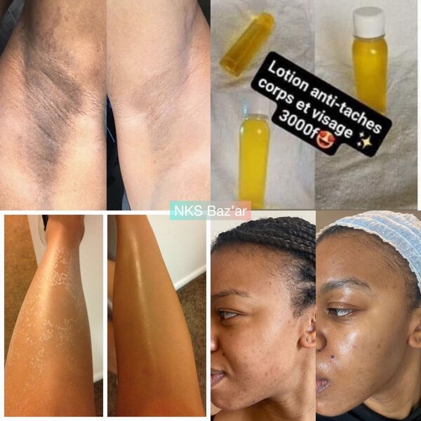 Traite les taches et peaux mortes à partir de 10 jours