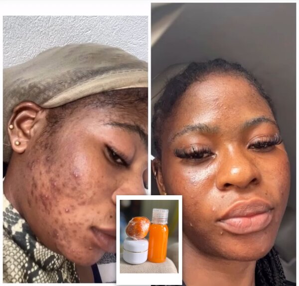 Soin Visage Anti-Acné Naturel