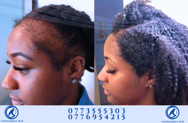 ORIGINAL MINOXIDIL 5% (men & women )