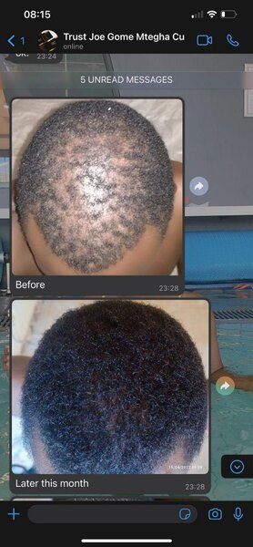 MINOXIDIL 5% (FOR MEN & WOMEN)