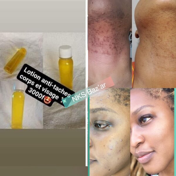 Finit les quinto, taches dacné, visage gras, peaux mortes