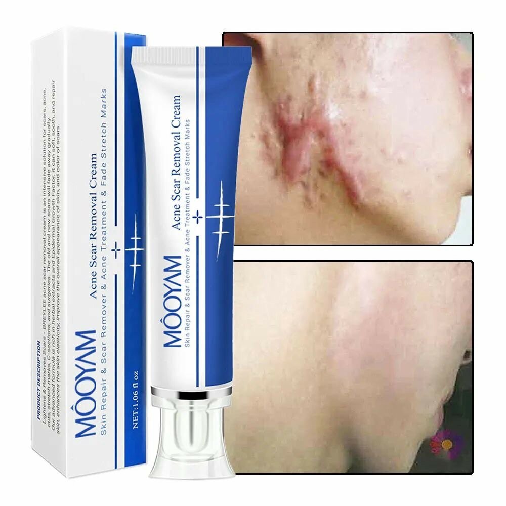 Scar remover cream
