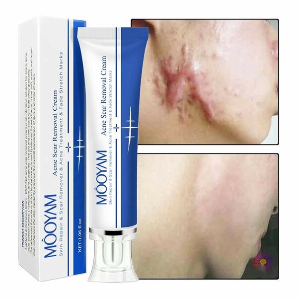 Scar remover cream
