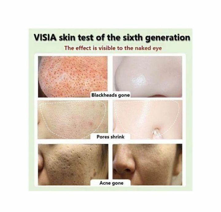 Soin de visage contre boutons