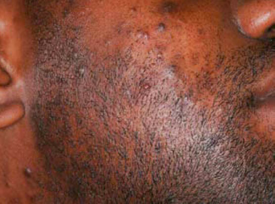 Savon bouton apres rasage