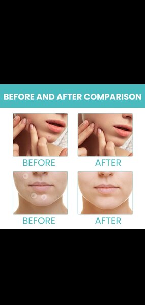 Circle pimple patches