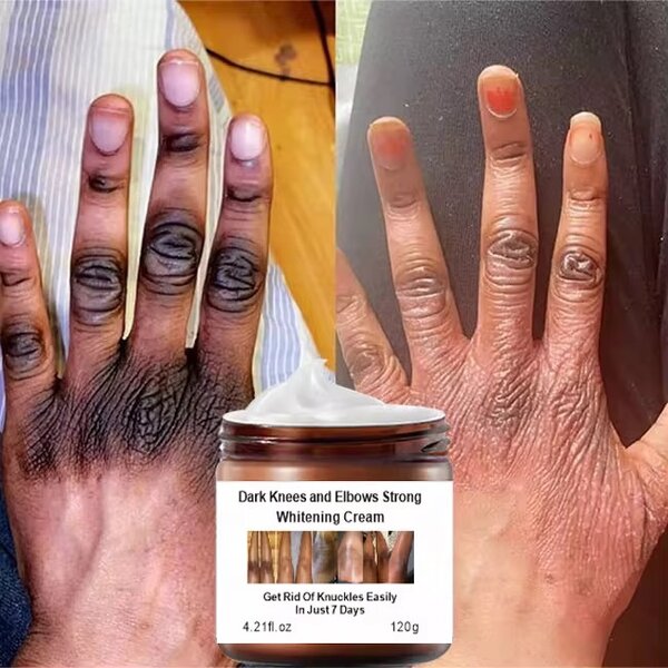 7Days_Mooyam Dark Knees, Elbows & Knuckles whitening Cream