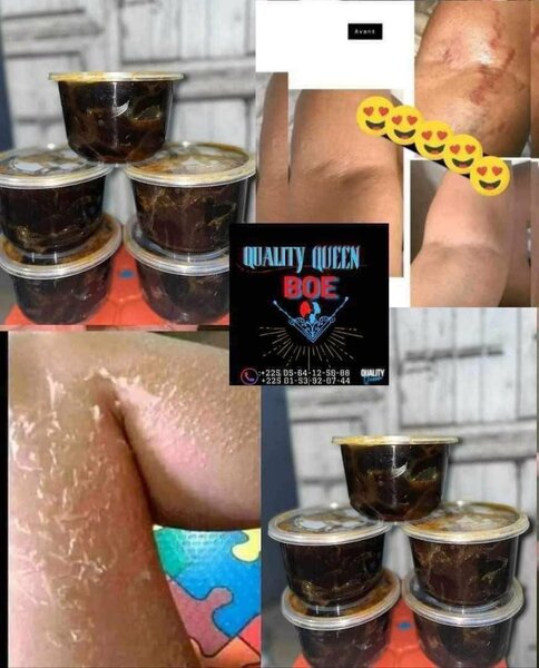 TRAITEMENT DE VERGETURES