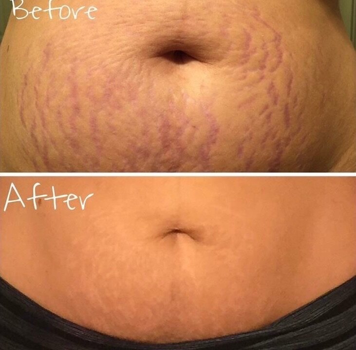 Kit Réducteur Vergetures