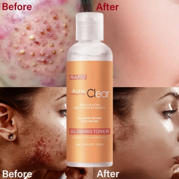 Toner/ lotion visage acide salicylique