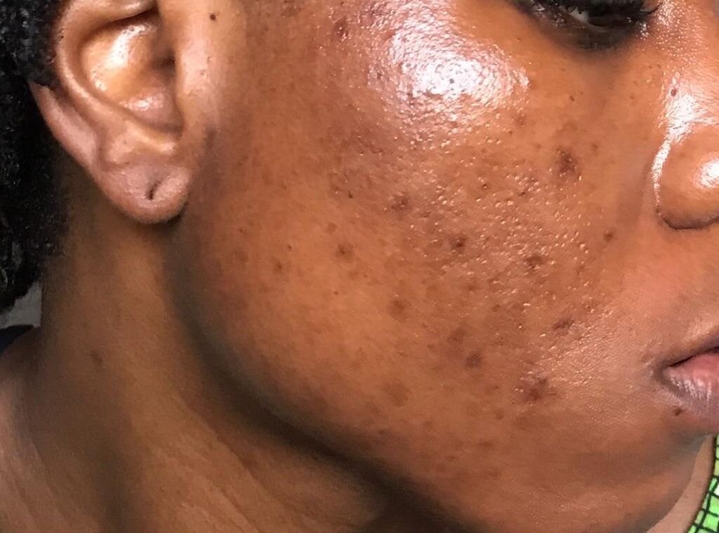 Nettoyant Visage Anti-Acné Tomate 100ml