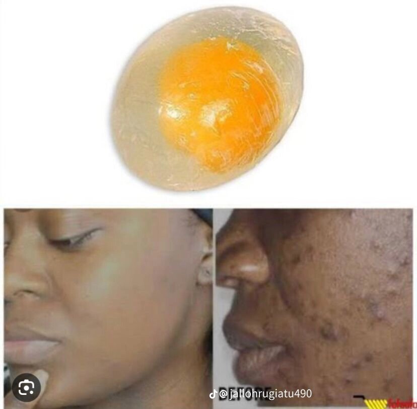 Savon œuf anti-acné