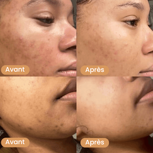 Disques Nettoyants Kojic & Curcuma