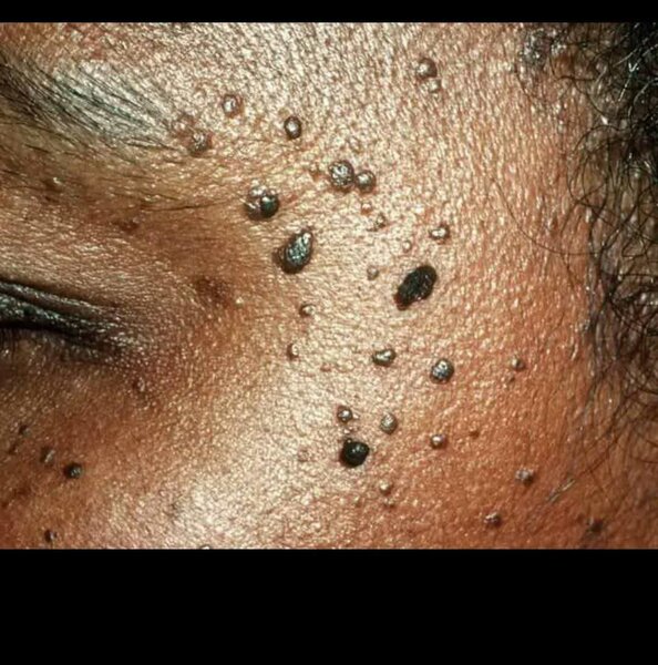 Anti wart/Skin tag cream