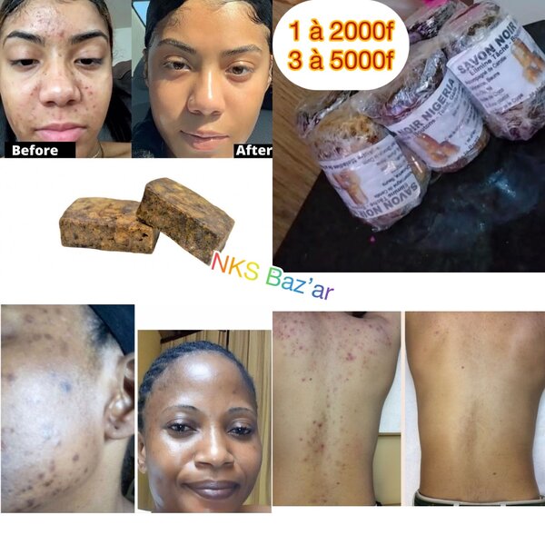 Plus de boutons et tâches avec ce savon