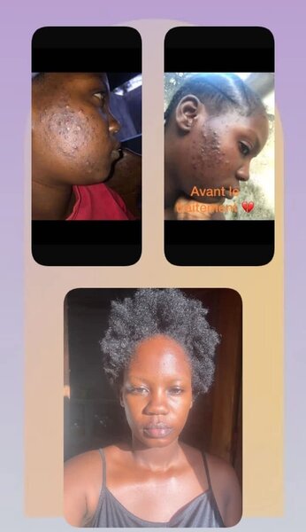 Gommage anti imperfections