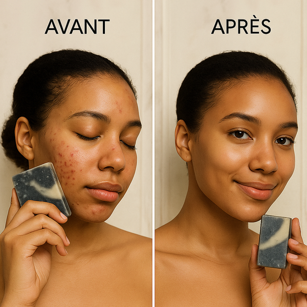Savon Purifiant Anti-Acné