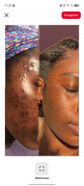 Sérum Anti-Acné Puissant