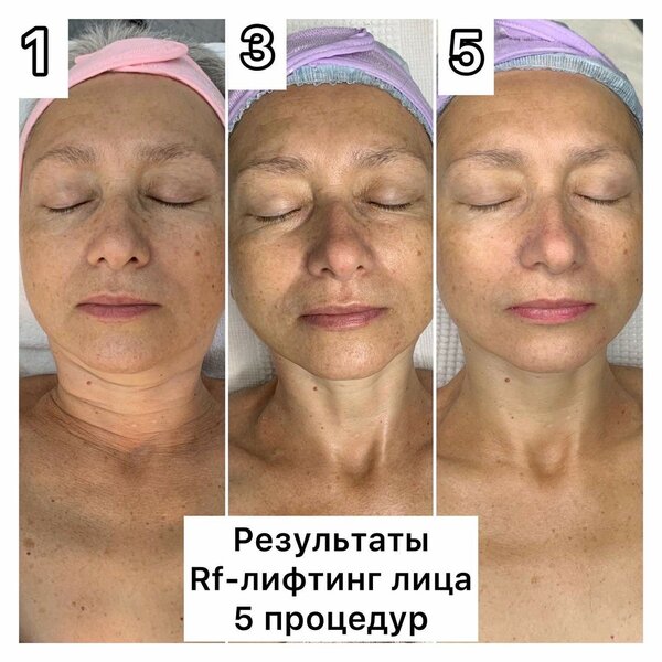 Кавитация + rf лифтинг по лицу