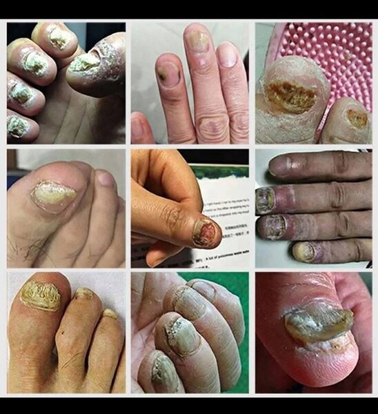 Traitement antifongique des ongles 7 Days