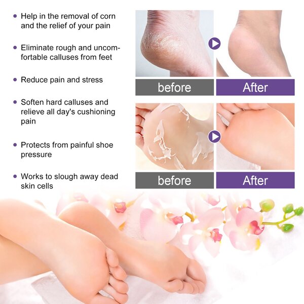 Foot peeling mask