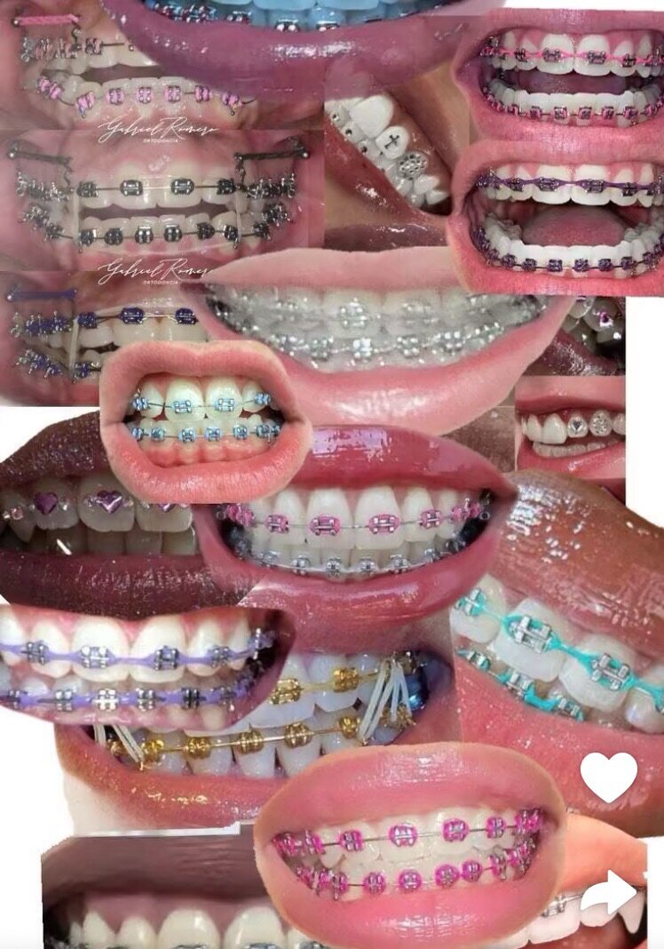 Braces