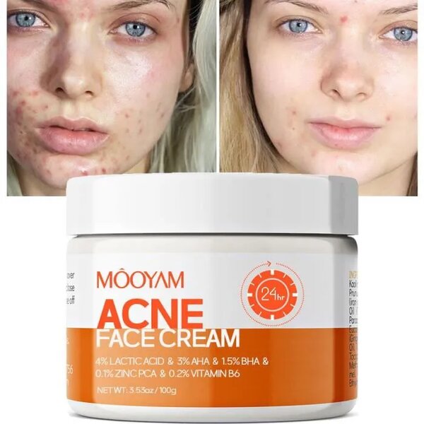 Crème Anti-Acné Efficace MOOYAM