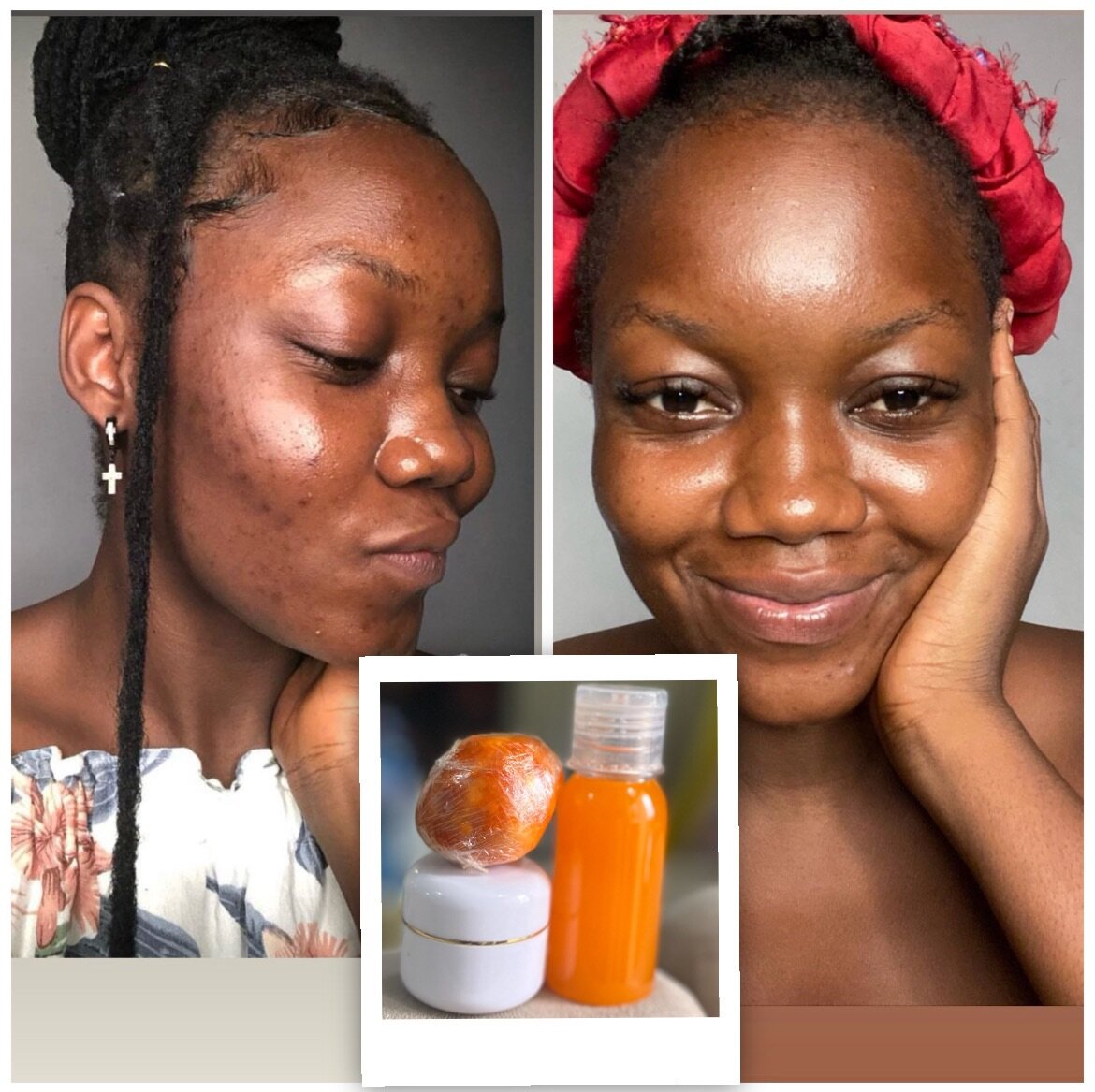 Soin Visage Anti-Acné Naturel