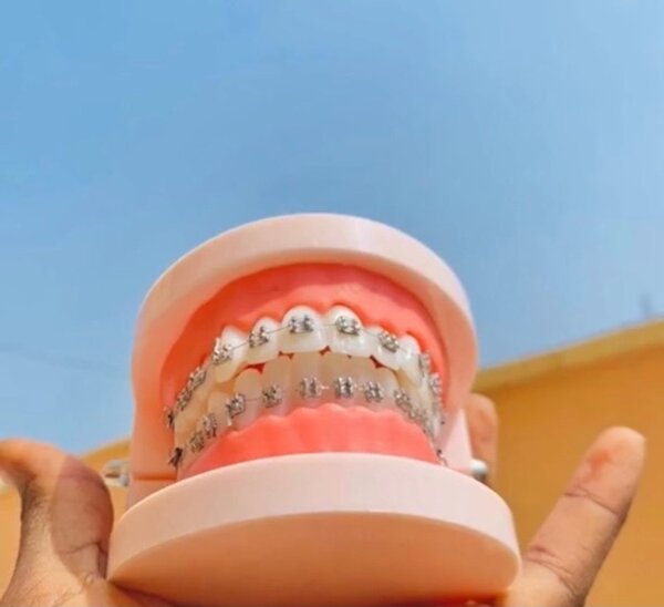 Appareils dentaire fake