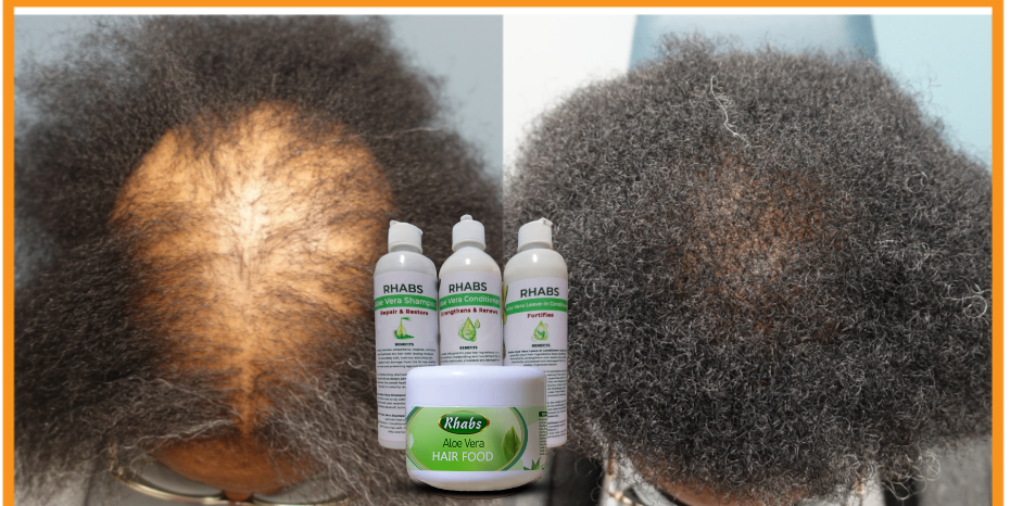 Rhabs Aloe Vera Hair Growth & Treatment Set