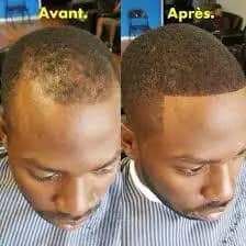 Fini avec la calvitie les chutes de cheveux  en 15 jours