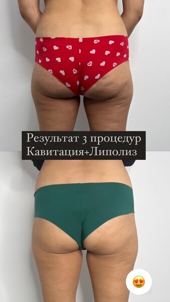 Кавитация + rf лифтинг по лицу