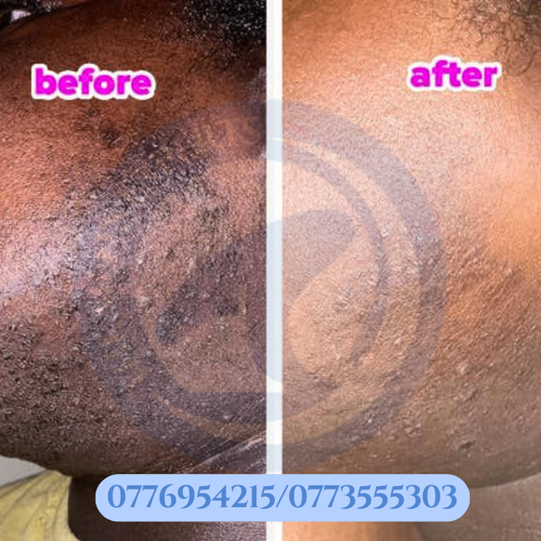 STOP HAIR (Hair inhibitor)