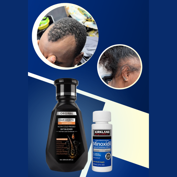 Minoxidil+shampoing antichute