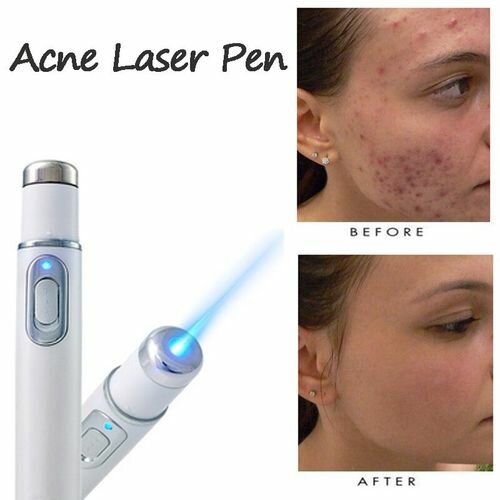 Stylo laser anti-acné portable