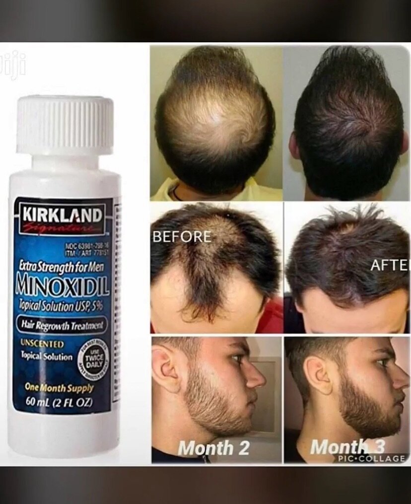BIOTIN MINOXIDIL AND DERMA ROLLER