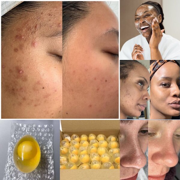 Empêche l'apparition des boutons ,les taches et dégraisse