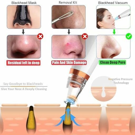 Acne Pimple Pore Remover