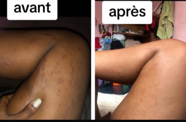 Savon  de vergetures