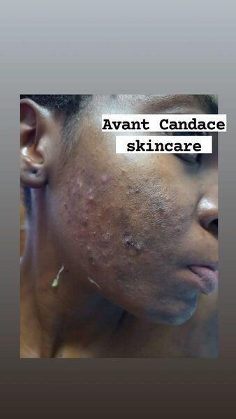 Pack anti imperfections