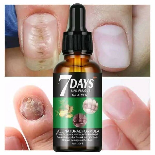 Traitement Antifongique Ongles Naturel
