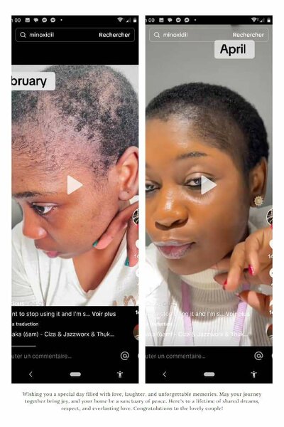 Minoxidil, repousse garantie