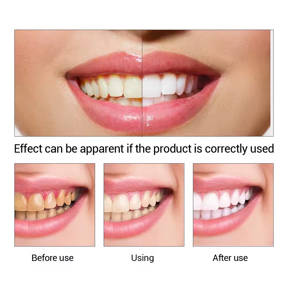 Teeth Whitening Gel