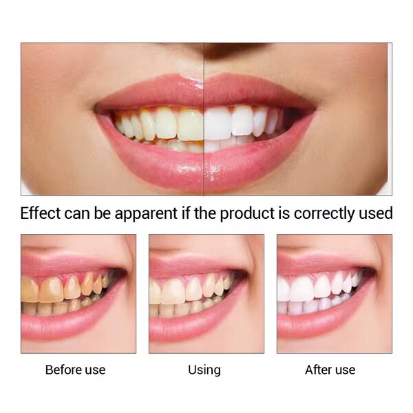 Teeth Whitening Gel